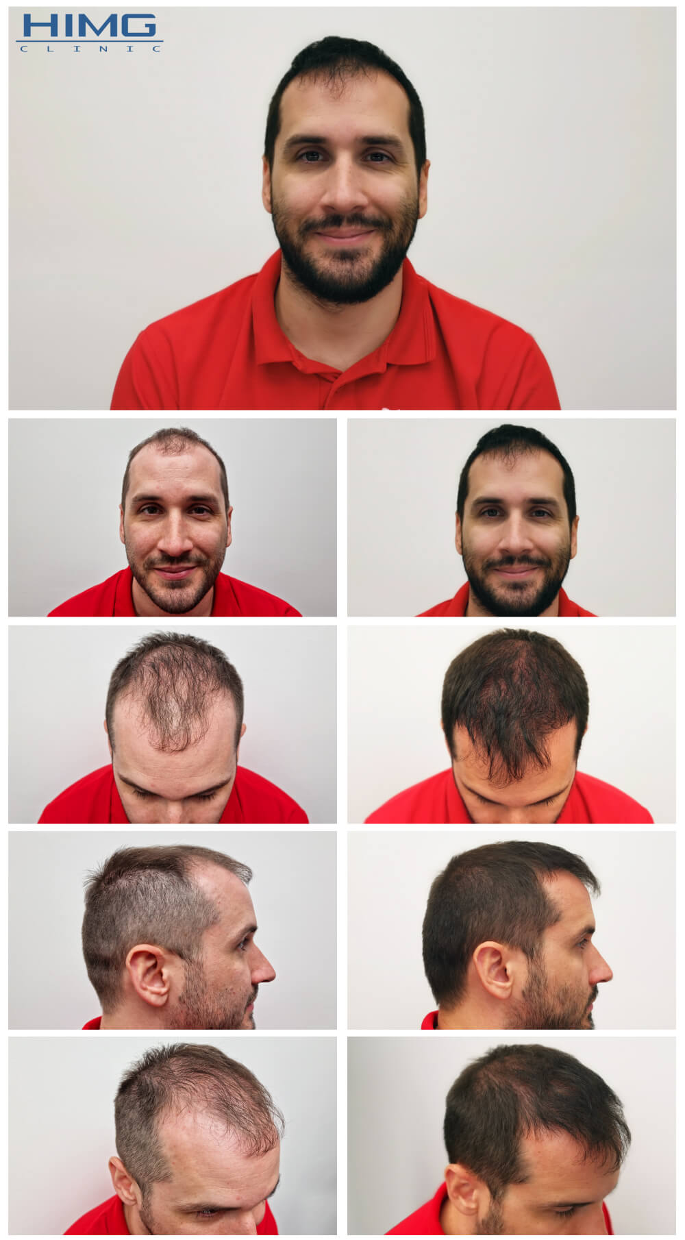 Hajbeültetés utáni eredmény