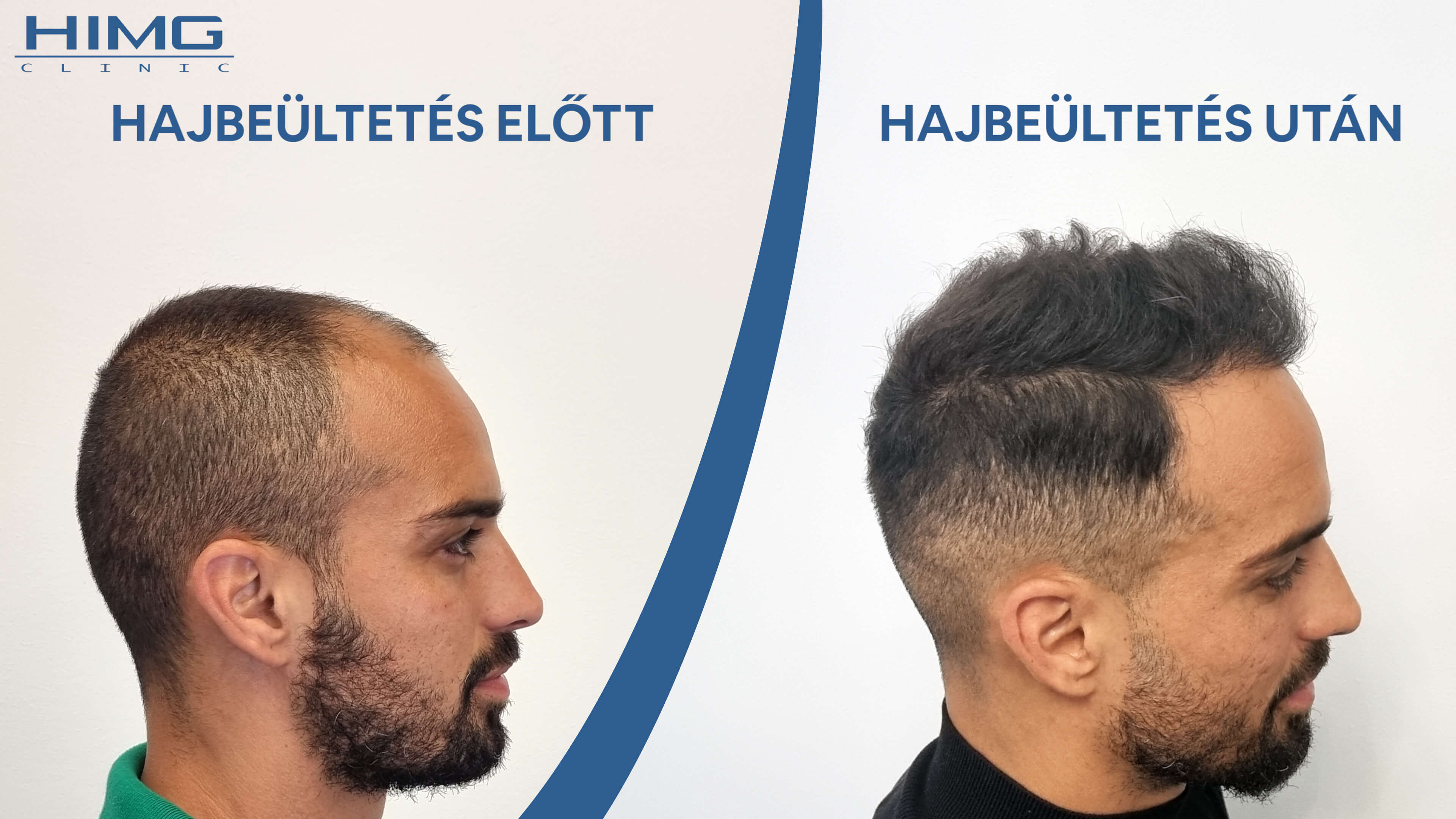 A budapesti HIMG klinikán történt hajbeültetés eredménye
