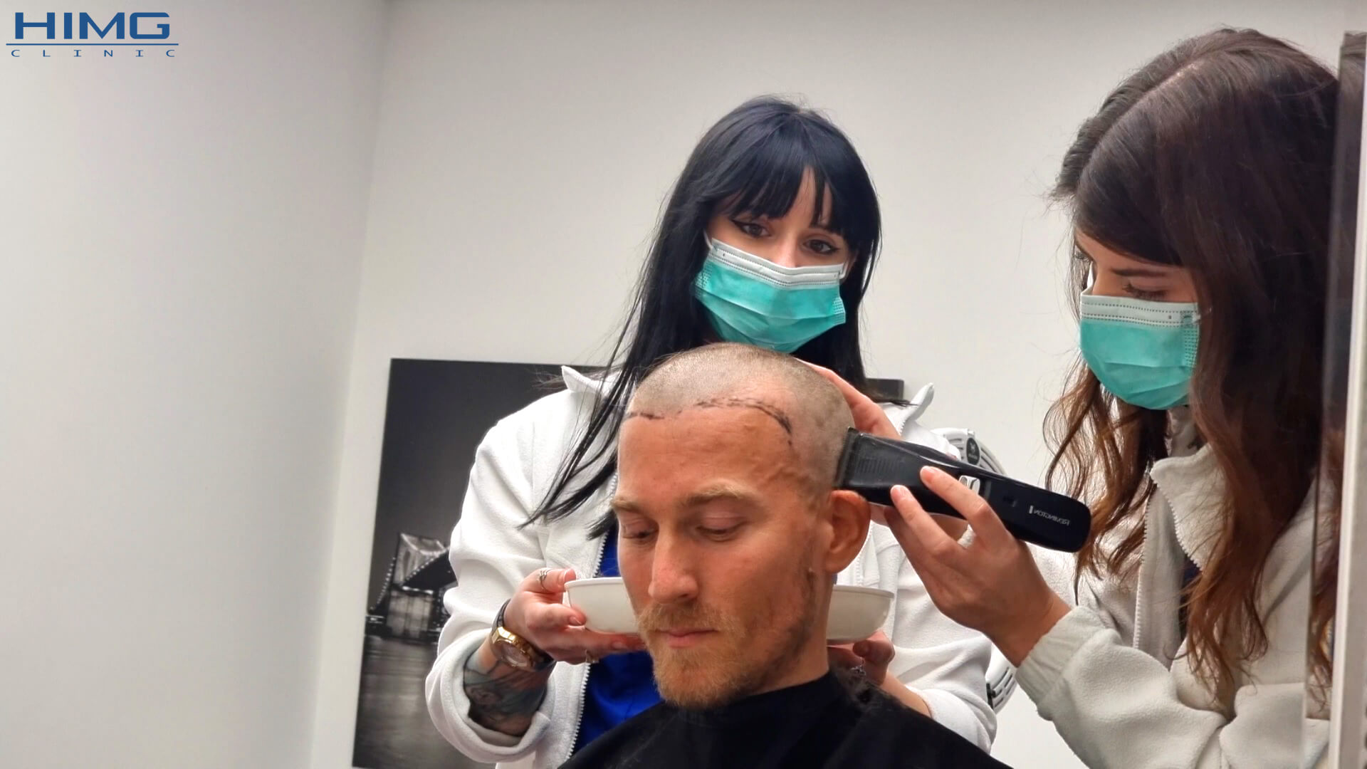 8+1 tévhit a hajbeültetésről