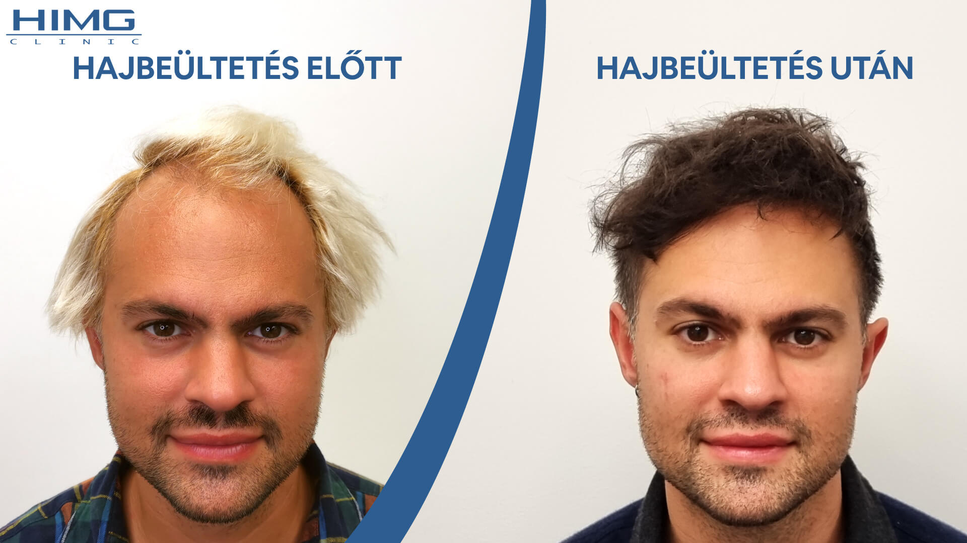 Hajbeültetés előtte-utána: Novkov Máté - HIMG hajbeültetési klinika