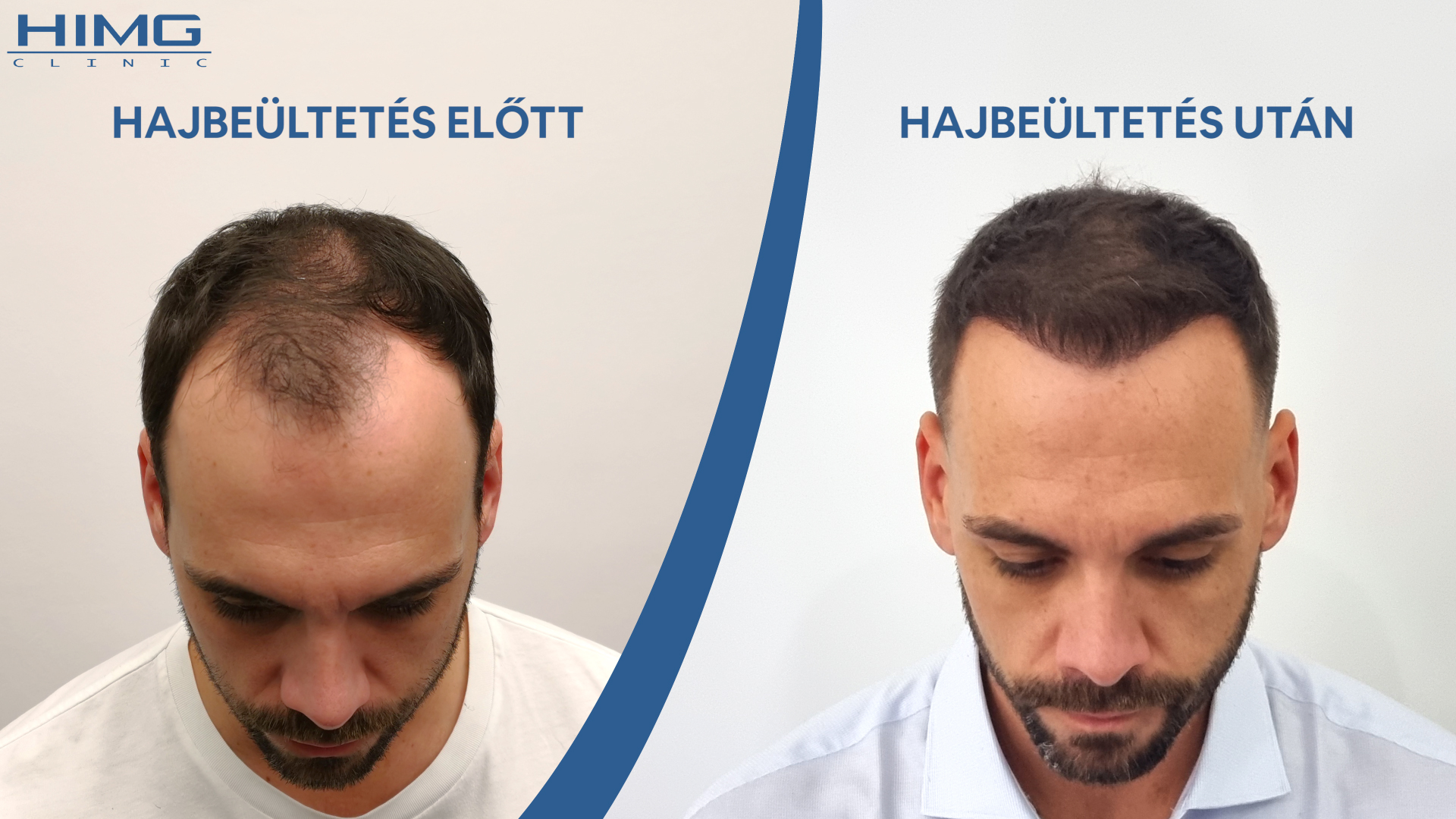 Balázs hajbeültetés előtt és után