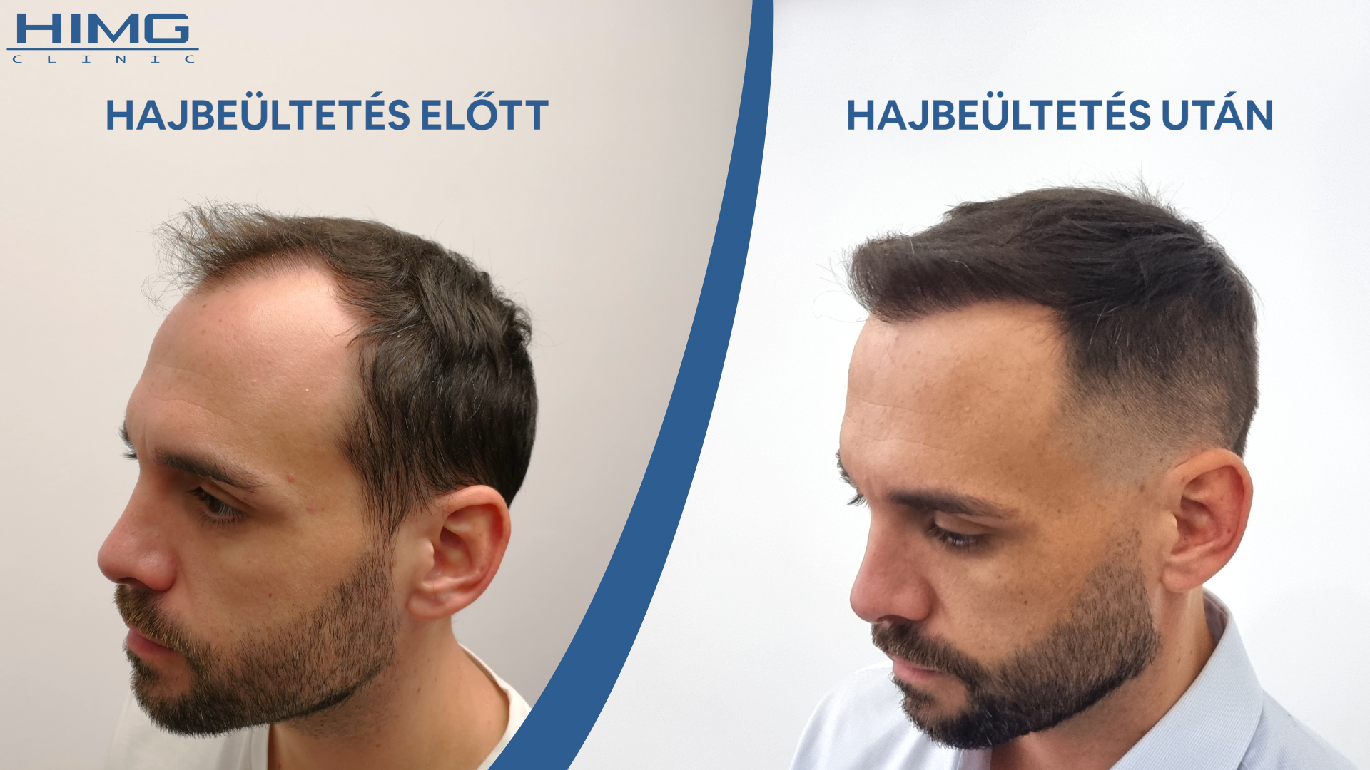 Balázs hajbeültetés előtt és után