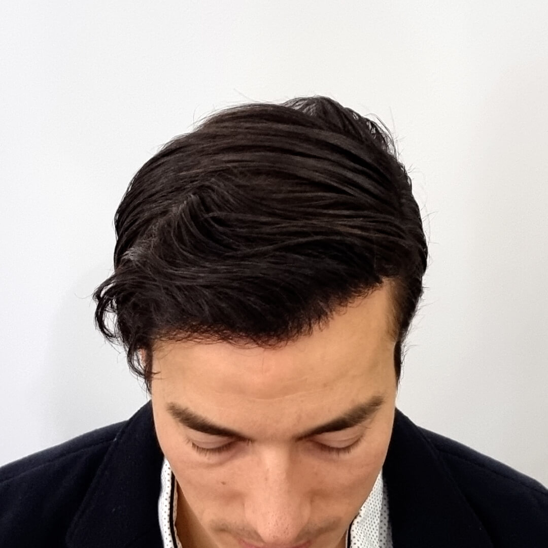 Gergő hajbeültetési eredménye a HIMG Klinika díjnyertes SHE hajbeültetési módszerével -2