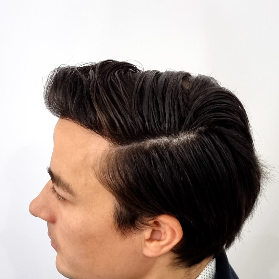 Gergő hajbeültetési eredménye a HIMG Klinika díjnyertes SHE hajbeültetési módszerével -4