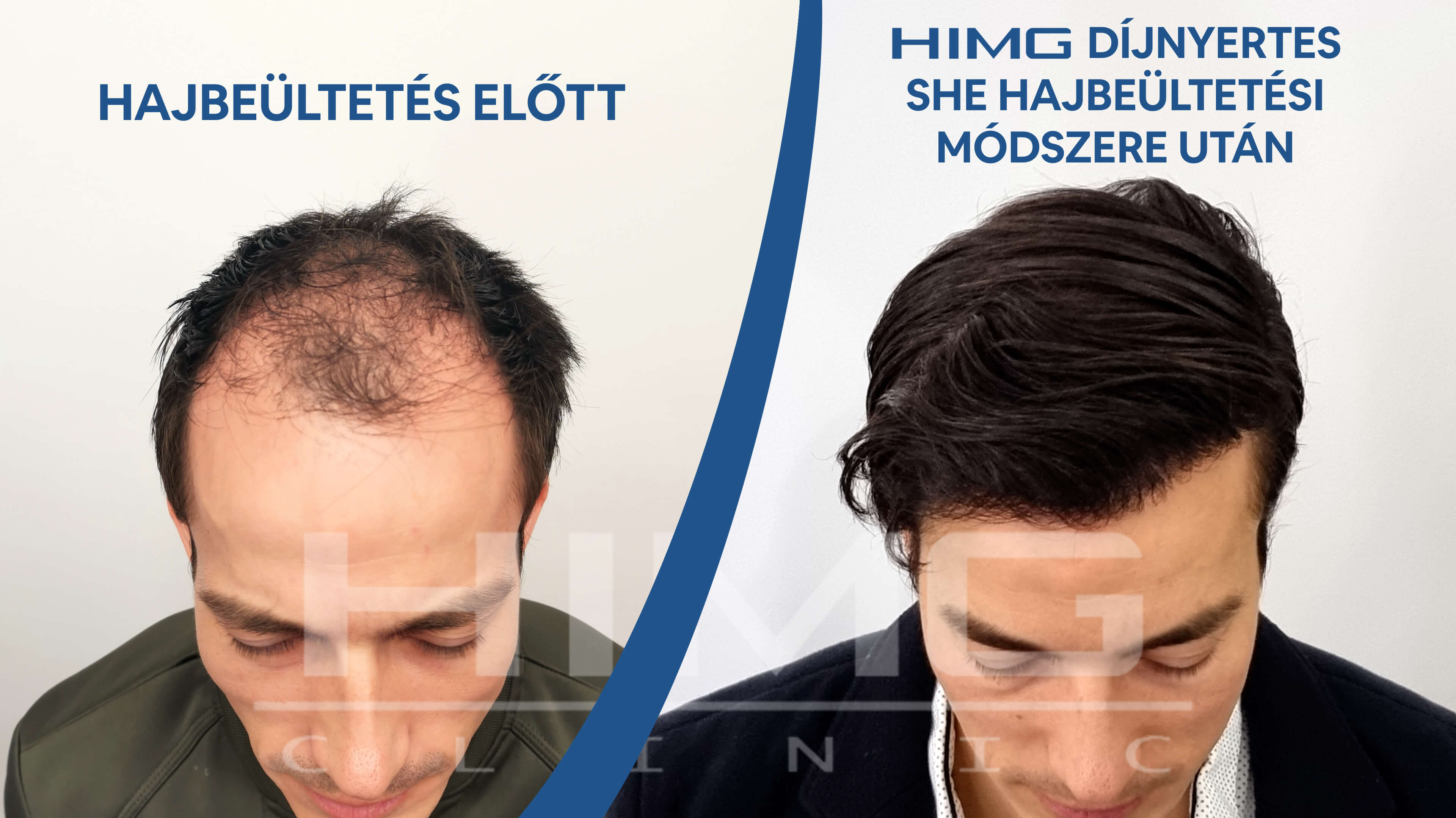 Hajbeültetés Törökországban