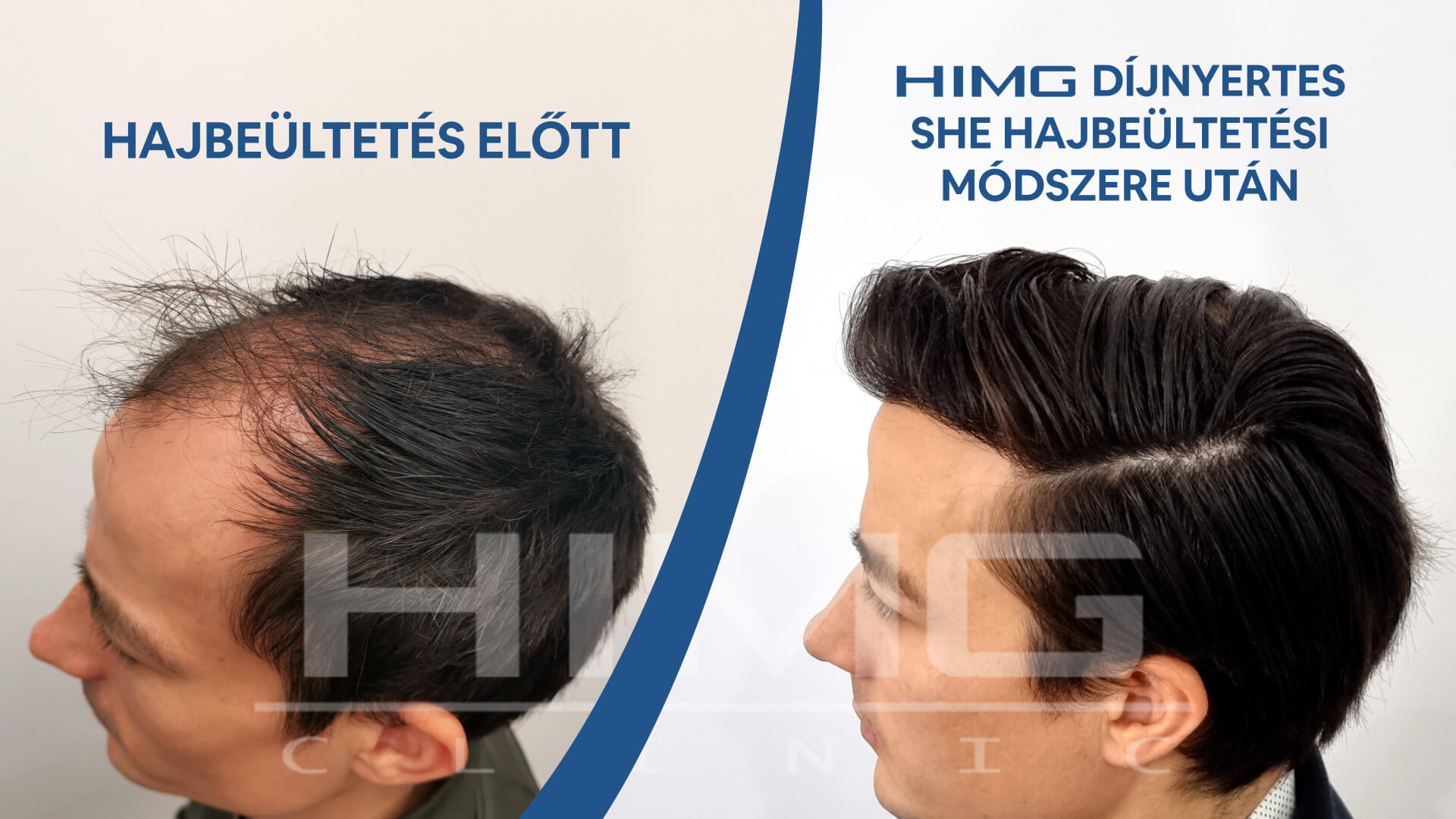 Hajbeültetés előtte-utána: Gergő - HIMG hajbeültetési klinika Hajbeültetés előtte-utána: Gergő - HIMG hajbeültetési klinika