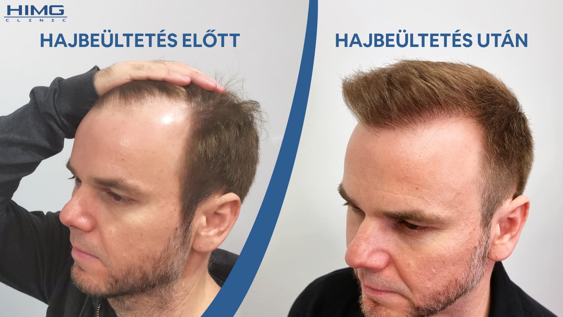 Hajbeültetés előtte utána (Juhász Gergely) - HIMG Hajbeültetés Klinika
