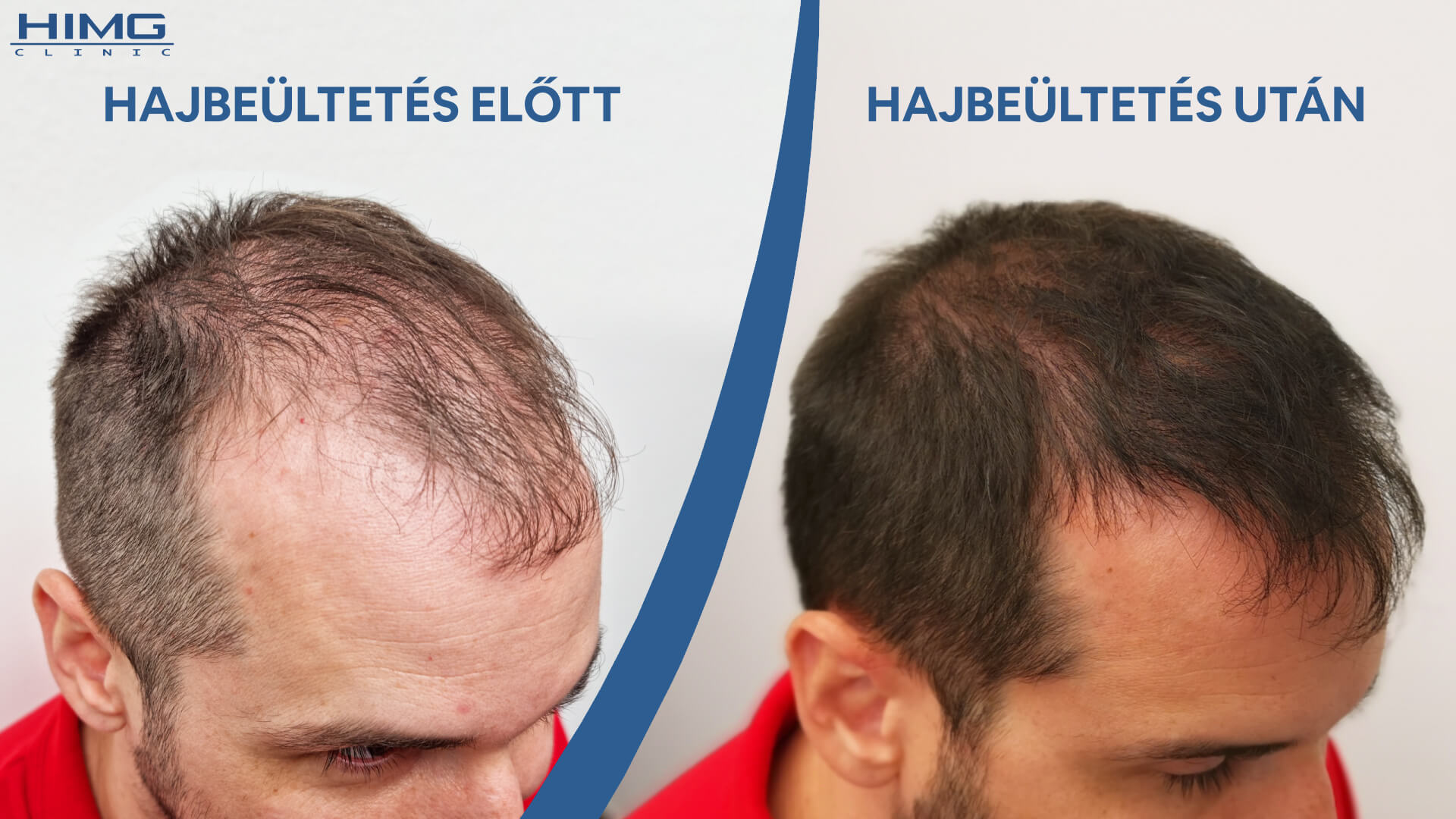 Hajbeültetés előtte utána (Kiss Norbert) - HIMG Hajbeültetés Klinika