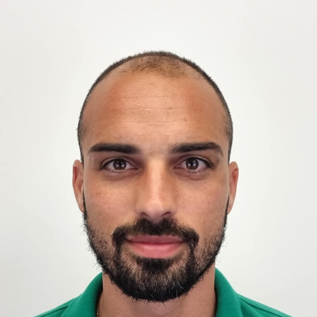 Hajbeültetés előtte-utána: M.D. Bertucci Lucas - HIMG hajbeültetési klinika