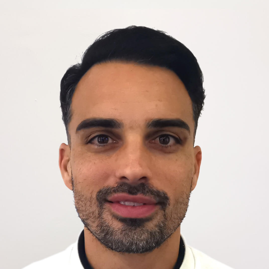 Hajbeültetés előtte-utána: M.D. Bertucci Lucas - HIMG hajbeültetési klinika