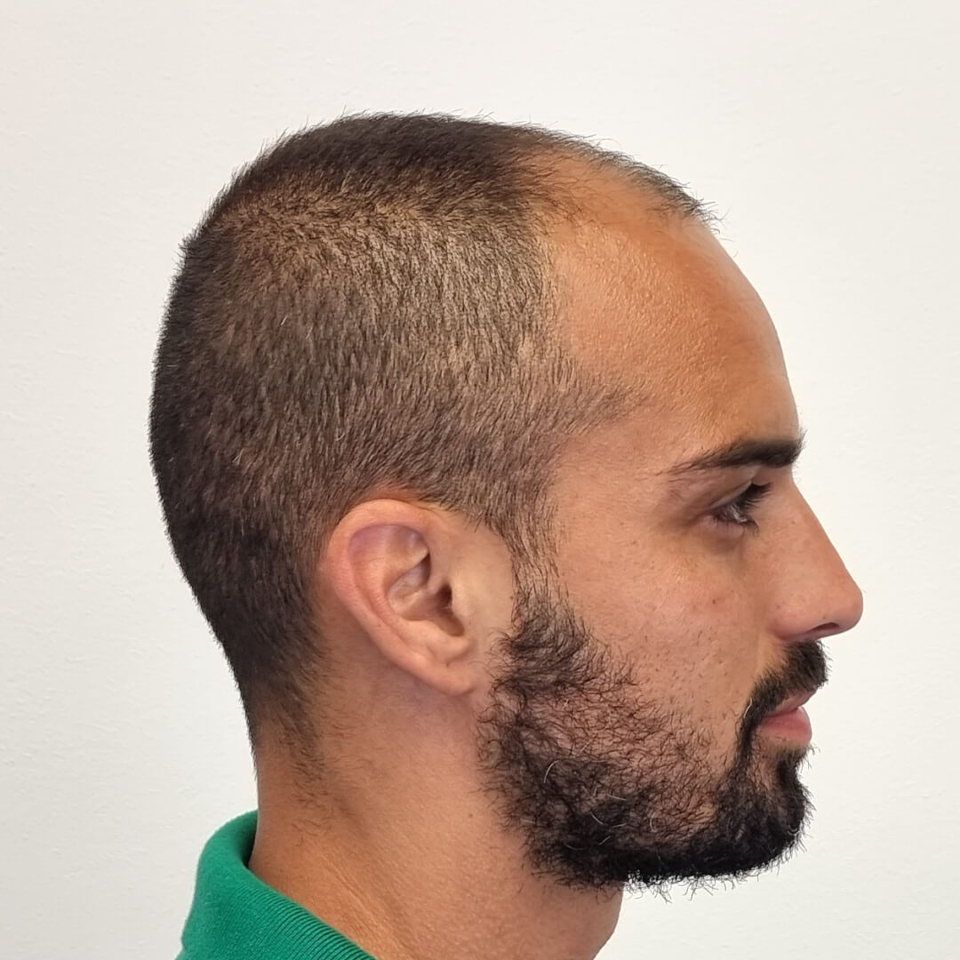 Hajbeültetés előtte-utána: M.D. Bertucci Lucas - HIMG hajbeültetési klinika