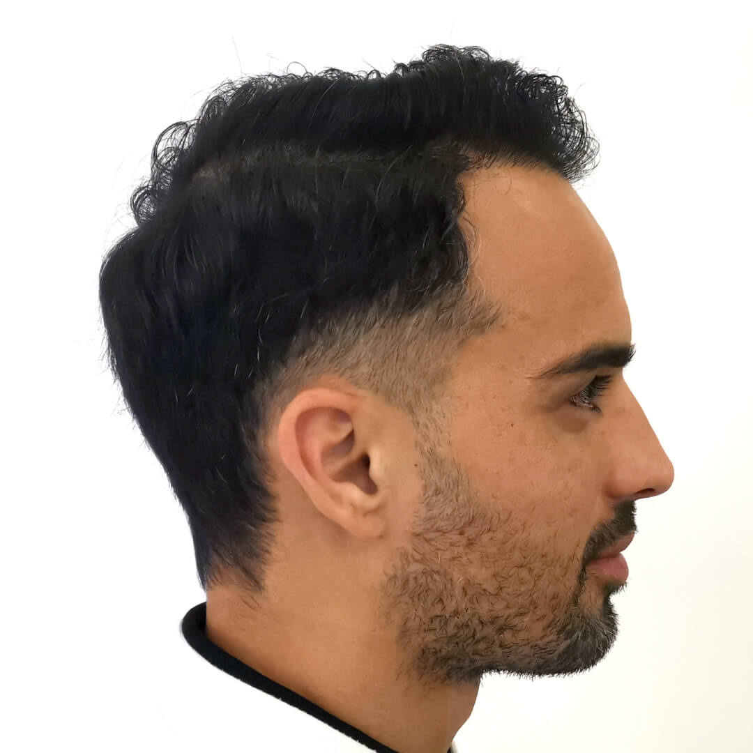 Hajbeültetés előtte-utána: M.D. Bertucci Lucas - HIMG hajbeültetési klinika