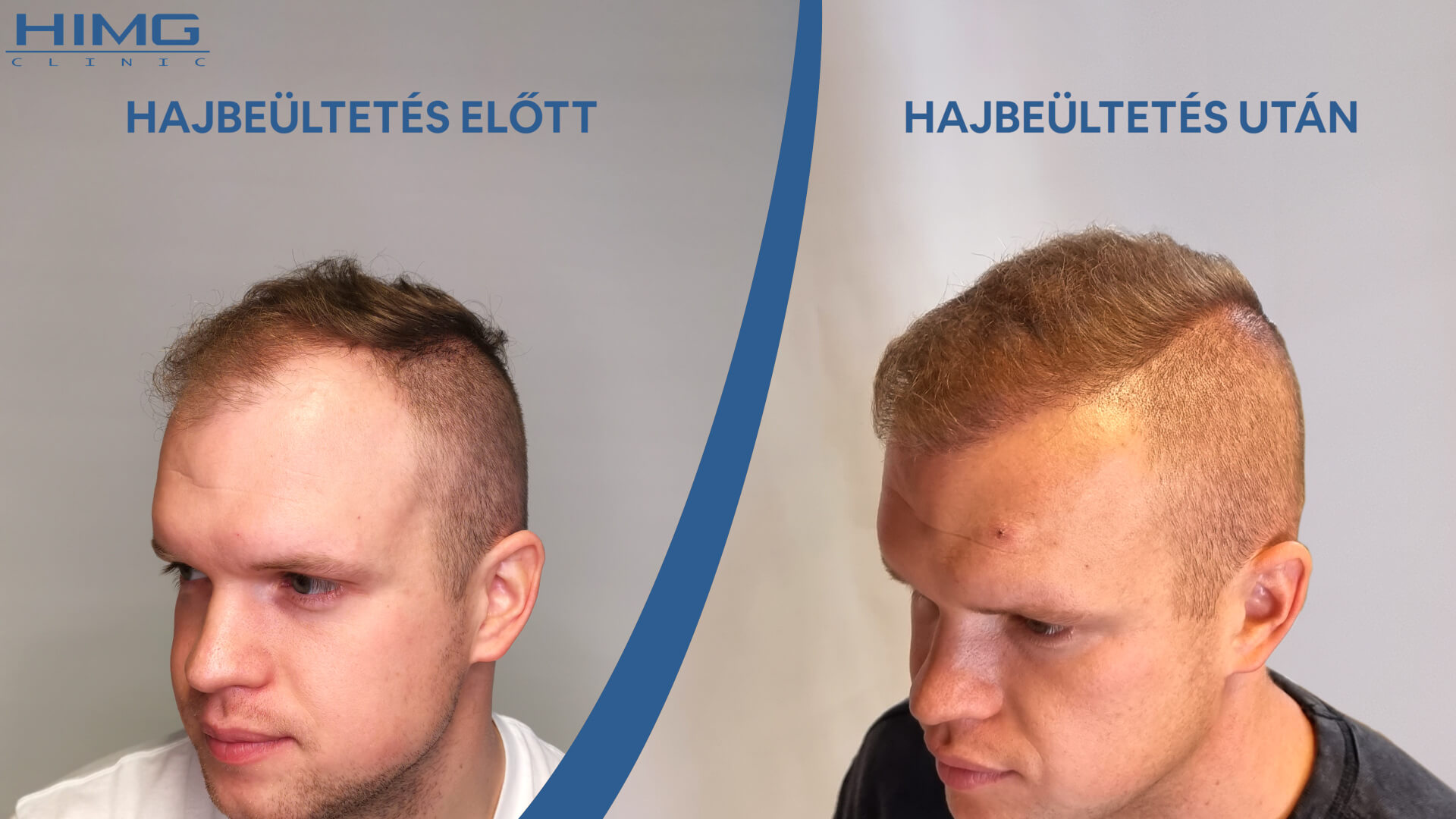 Hajbeültetés előtte-utána: Patrik - HIMG Klinika