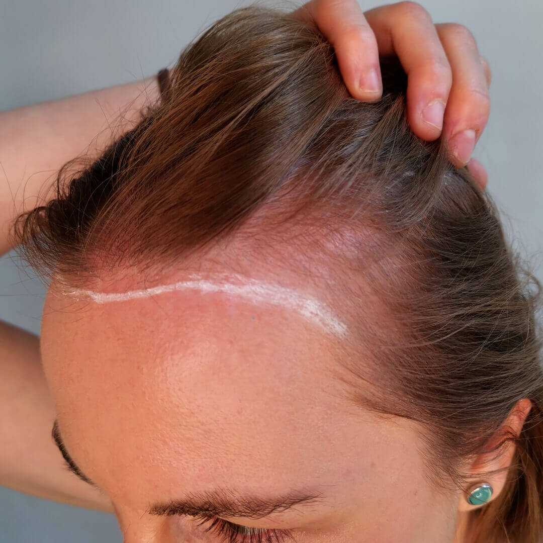 Ivana hajbeültetés előtte-utána eredménye (3000+ beültetett hajszál)