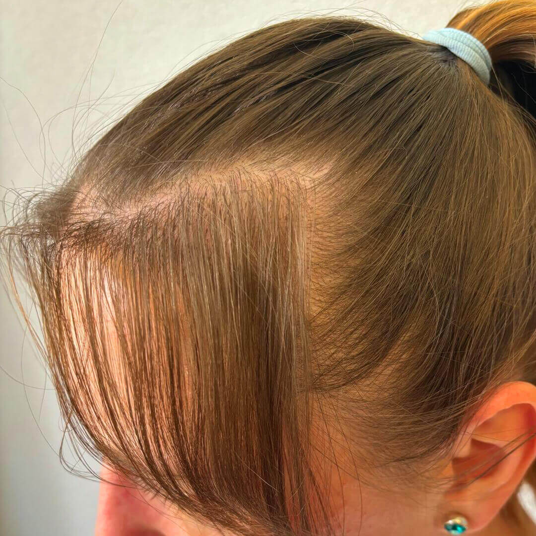 Ivana hajbeültetés előtte-utána eredménye (3000+ beültetett hajszál)