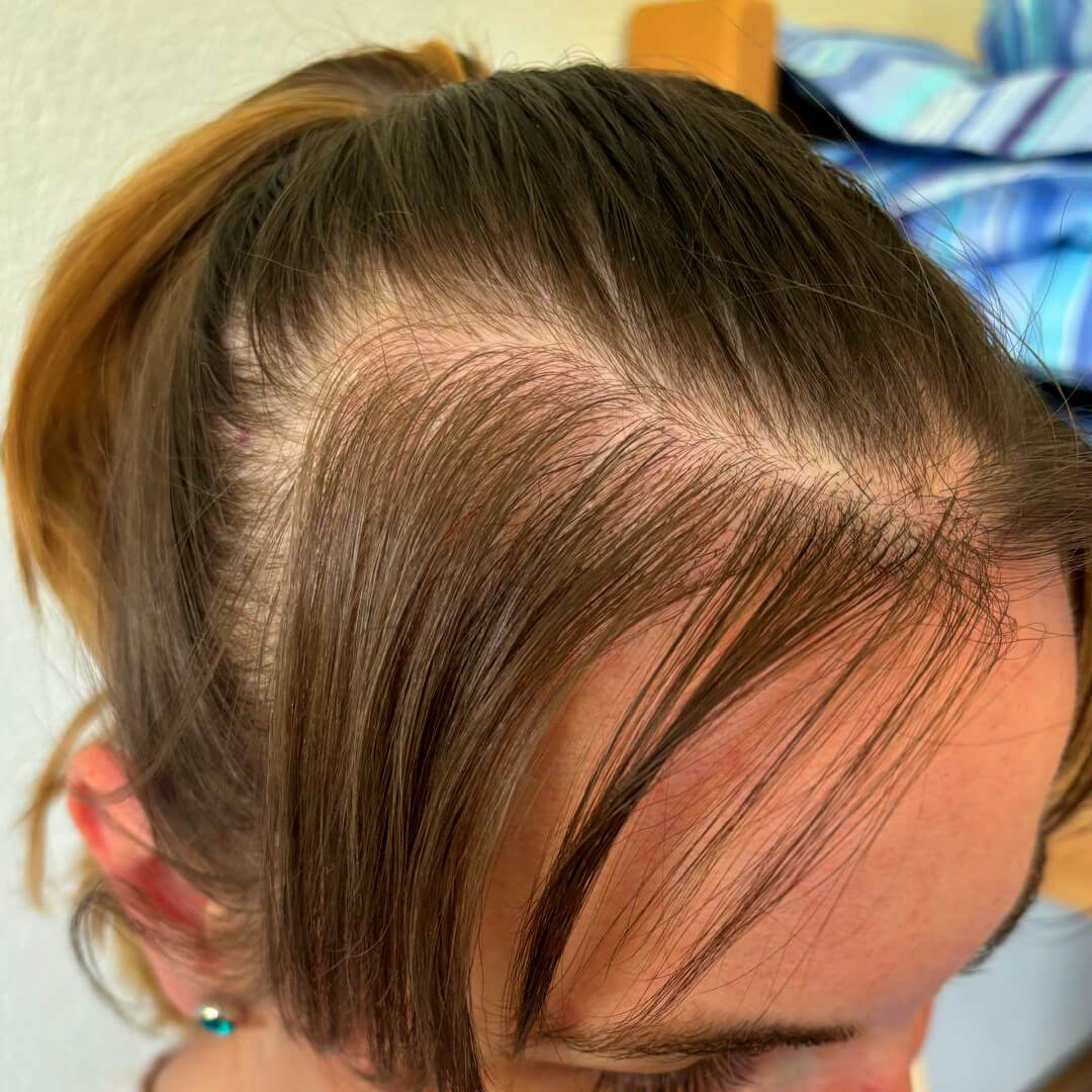 Ivana hajbeültetés előtte-utána eredménye (3000+ beültetett hajszál)