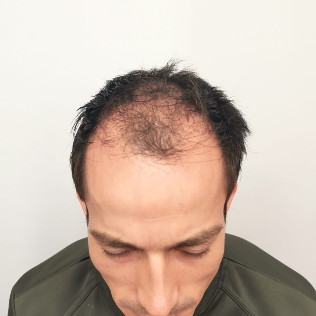 Gergő hajbeültetés előtt-után a HIMG Klinika díjnyertes SHE módszerével (9800+ beültetett hajszál)