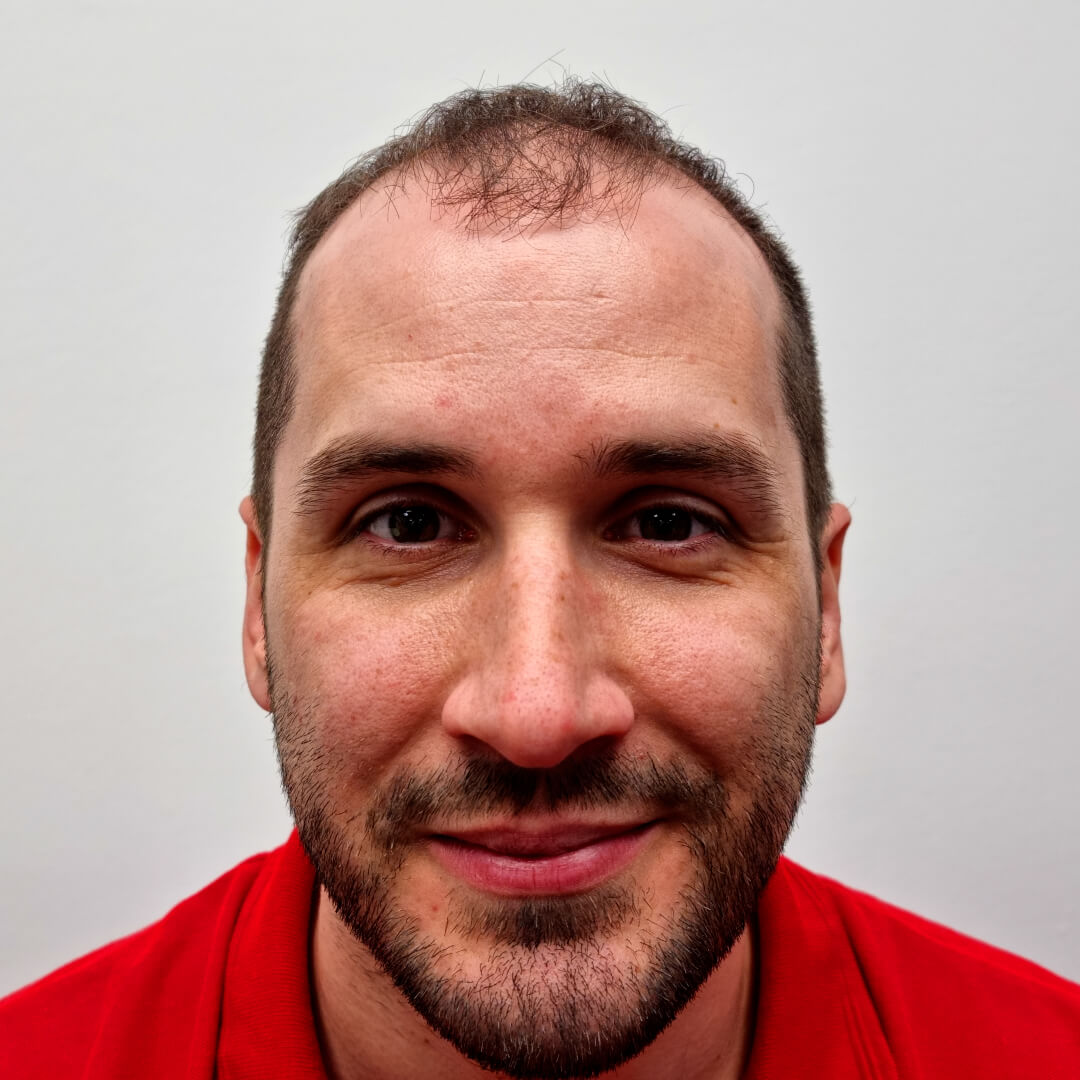 Kiss Norbert hajbeültetés előtt - HIMG hajbeültetési klinika