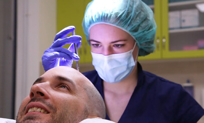 Hogyan működik a hajbeültetés?