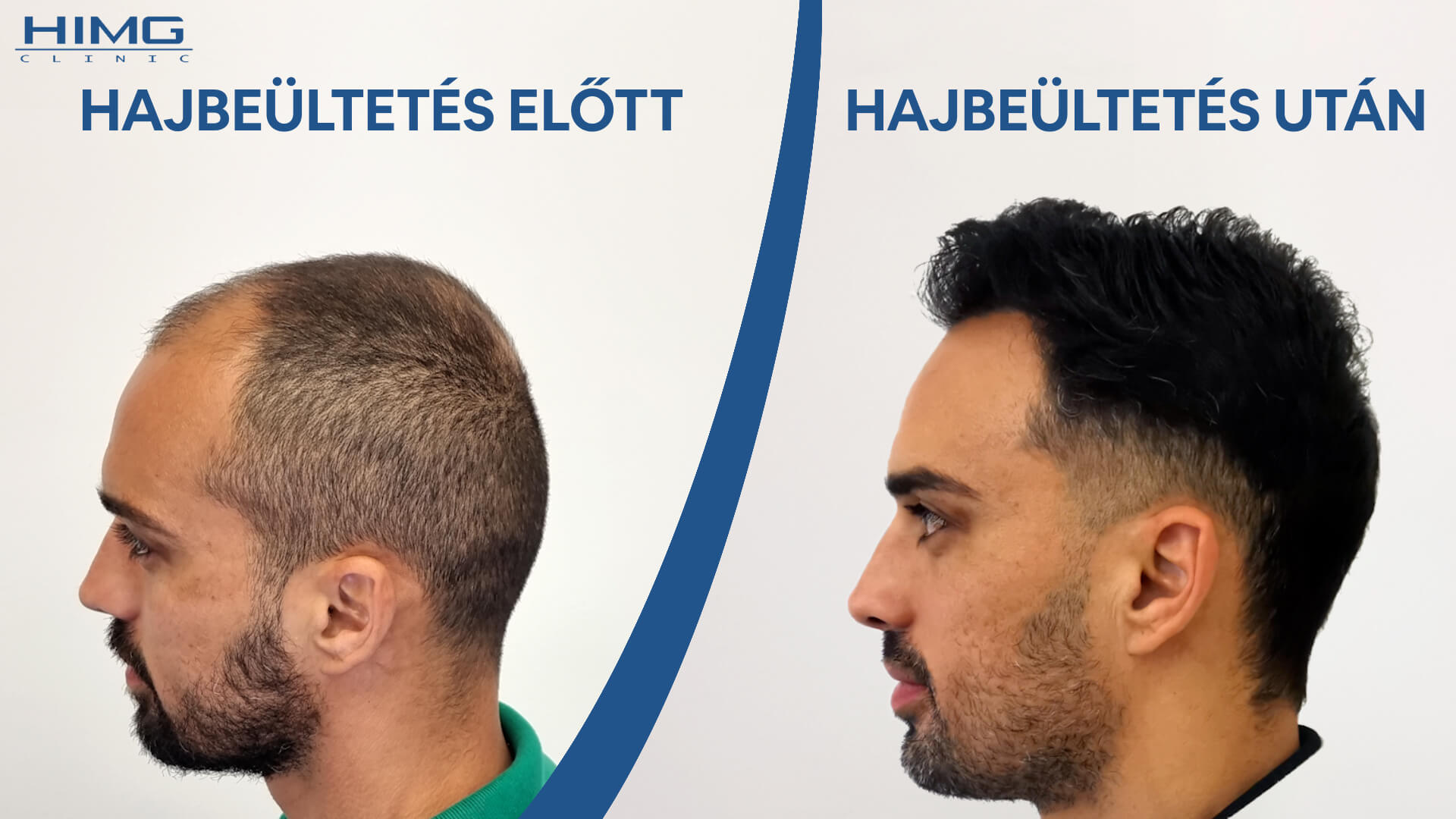 Hajbeültetés előtte-utána: Lucas - HIMG Klinika