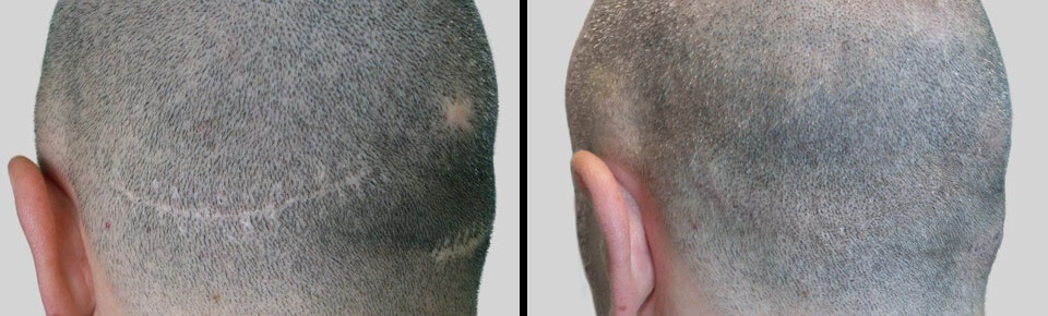 FUT és FUE okozta hegek a donor területen