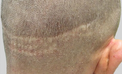 SMP (Fejbőr Mikropigmentáció) előtt