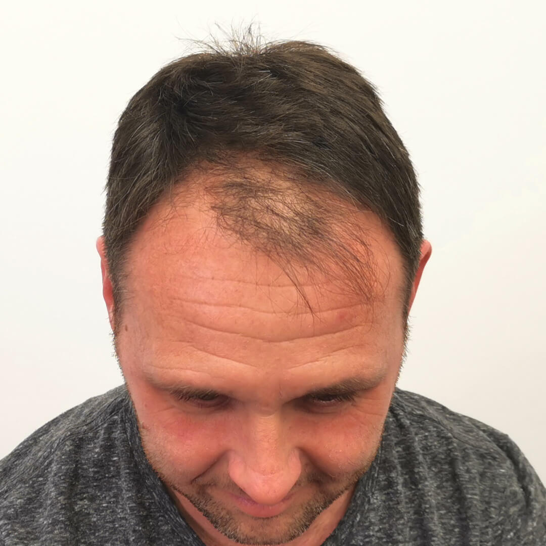 Hajbeültetés előtte-utána: József - HIMG hajbeültetési klinika