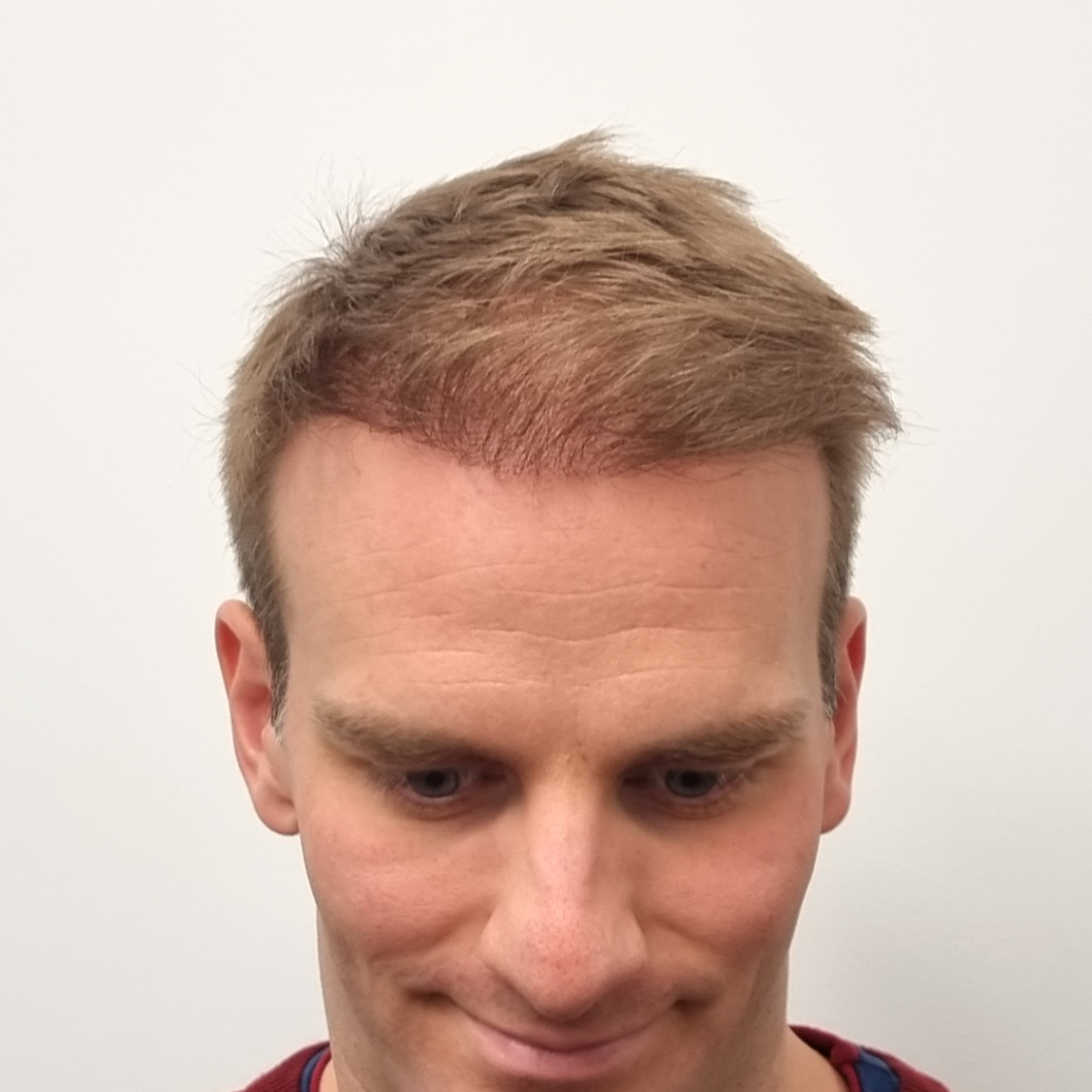 Hajbeültetés előtte-utána: Kókai Lénárd - HIMG Hajbeültetési Klinika