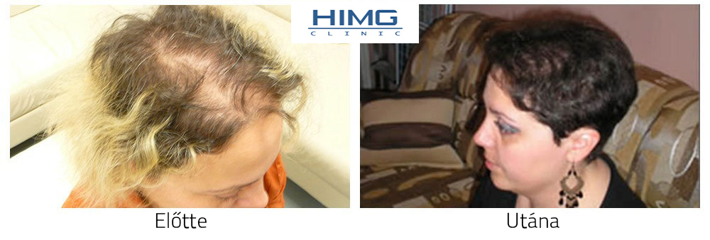 Hajtranszplantáció HIMG klinika