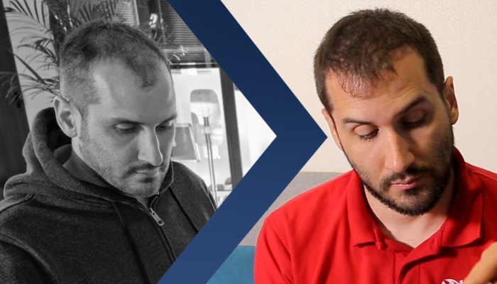 Hajbeültetés menete