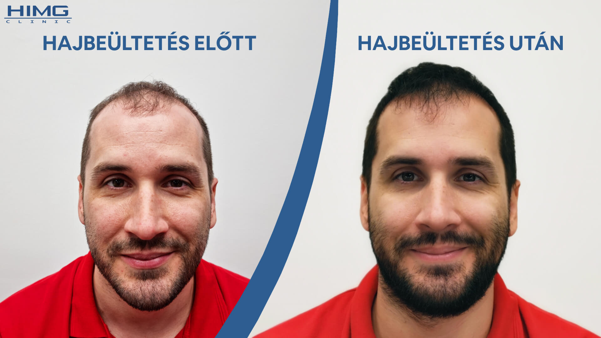 Hajbeültetés eredménye - Előtte és Utána