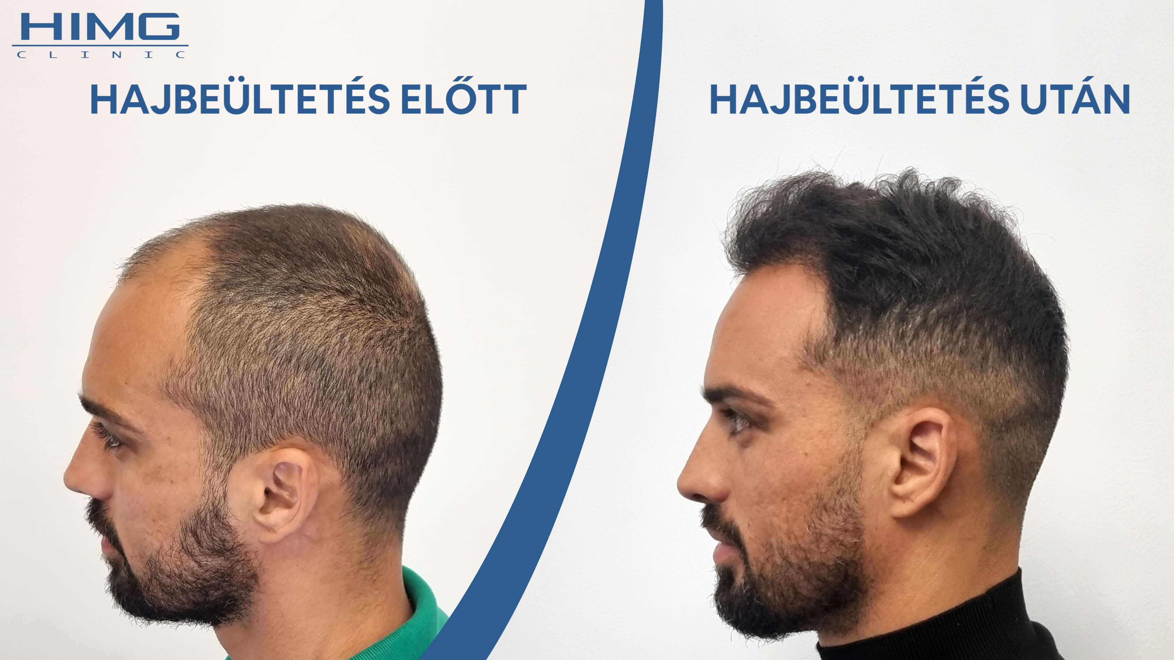 Hajbeültetés eredménye - Előtte és Utána