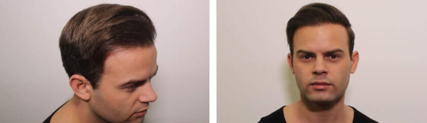 Férfi kopaszodás kezelése