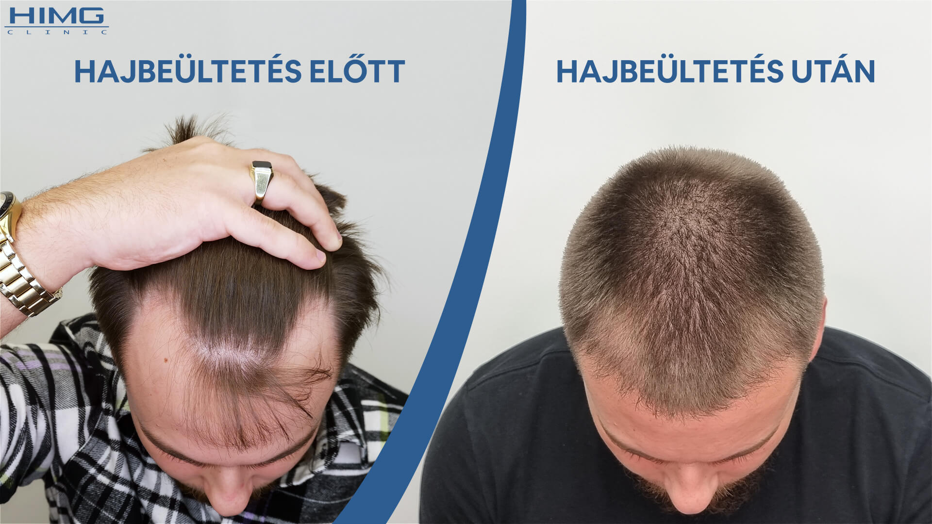 Georgios hajbeültetés előtt és után (2500+ beültetett hajszál) 