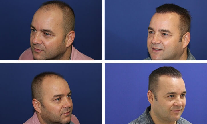 Hajbeültetés előtte-utána Hajbeültetés előtte-utána