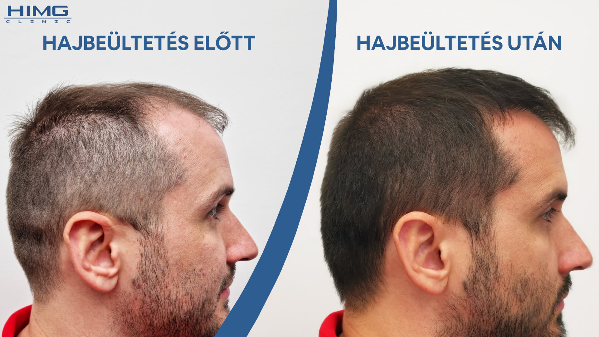 Hajbeültetés előtt és után