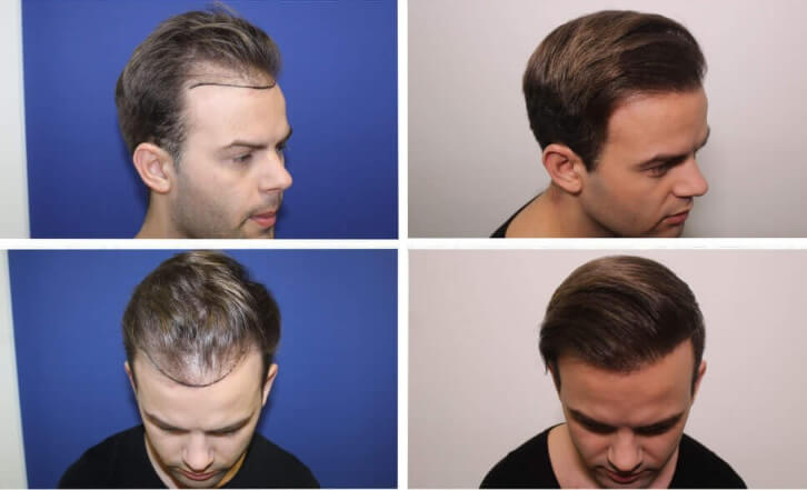 Hajbeültetés eredménye