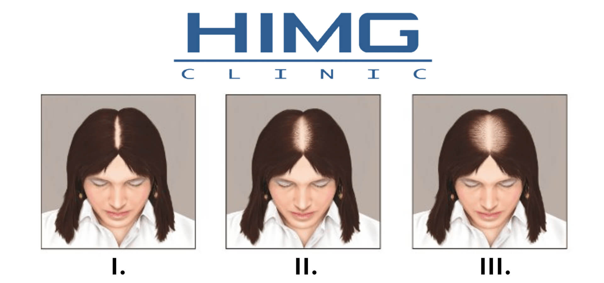 Ludwig Skála: A Nők Hajvesztési Stádiumai