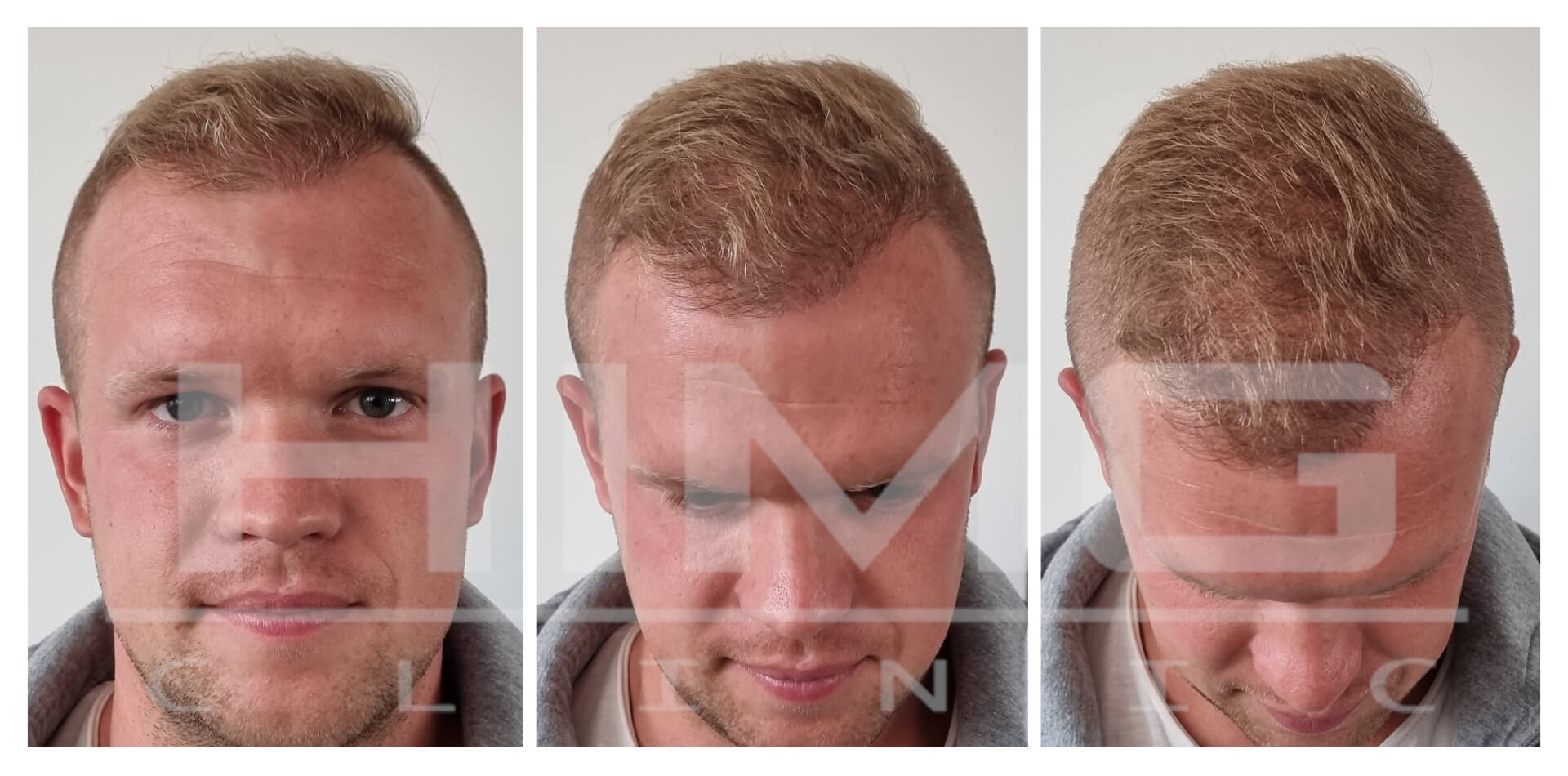 Patrik a hajbeültetés után 7 hónappal