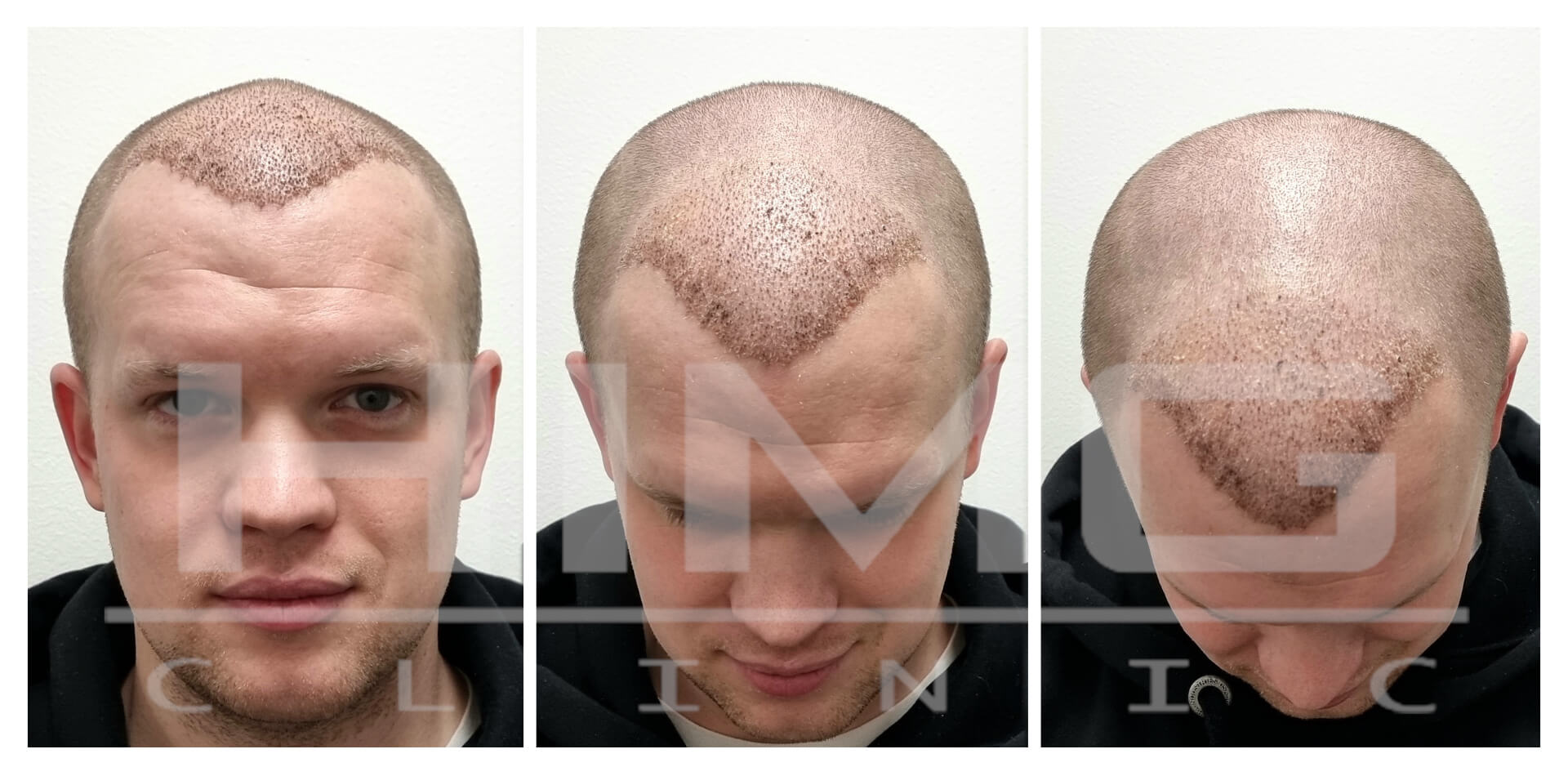 Hajbeültetés utáni első hét