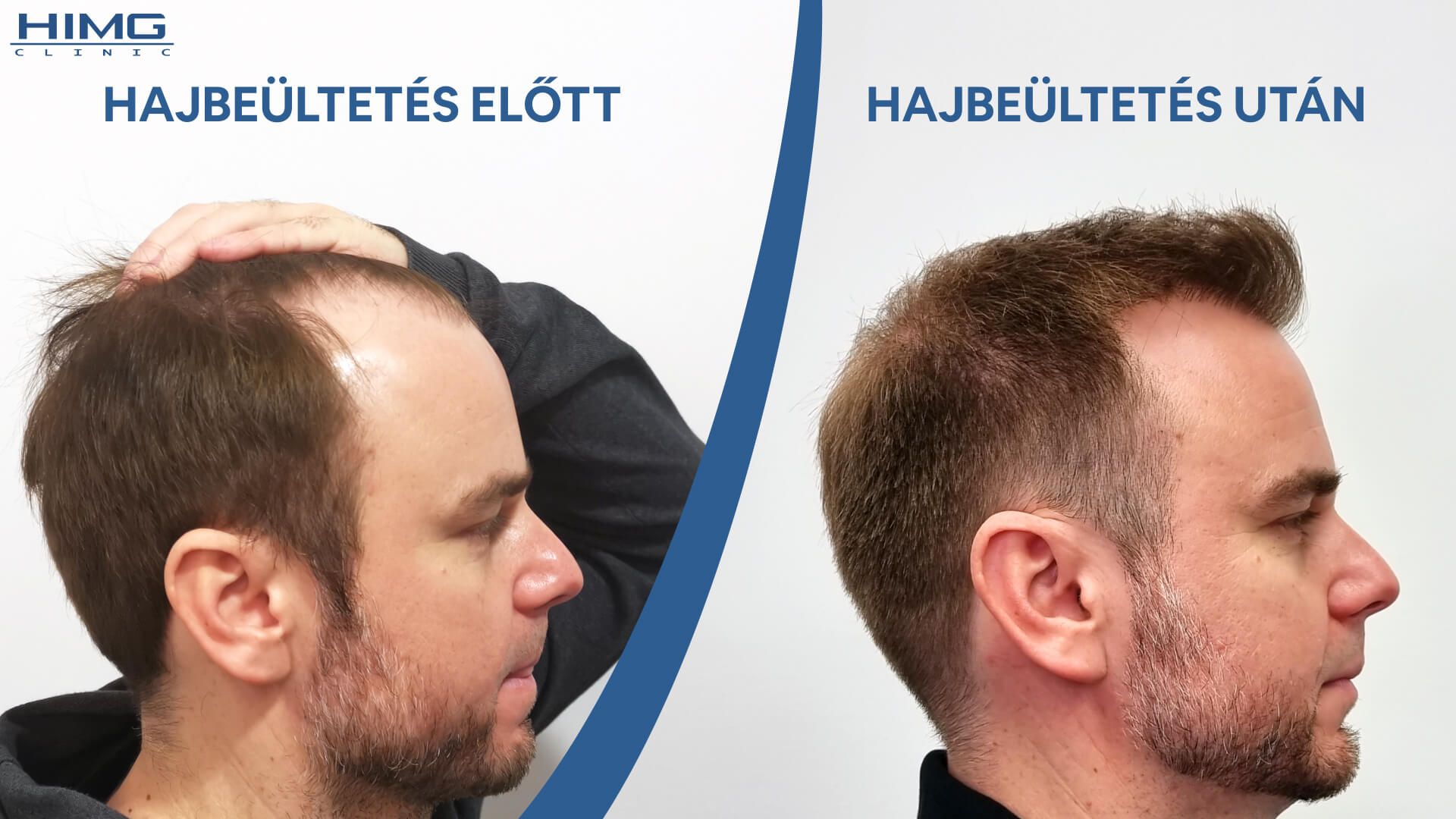 Hajbeültetés előtt és után