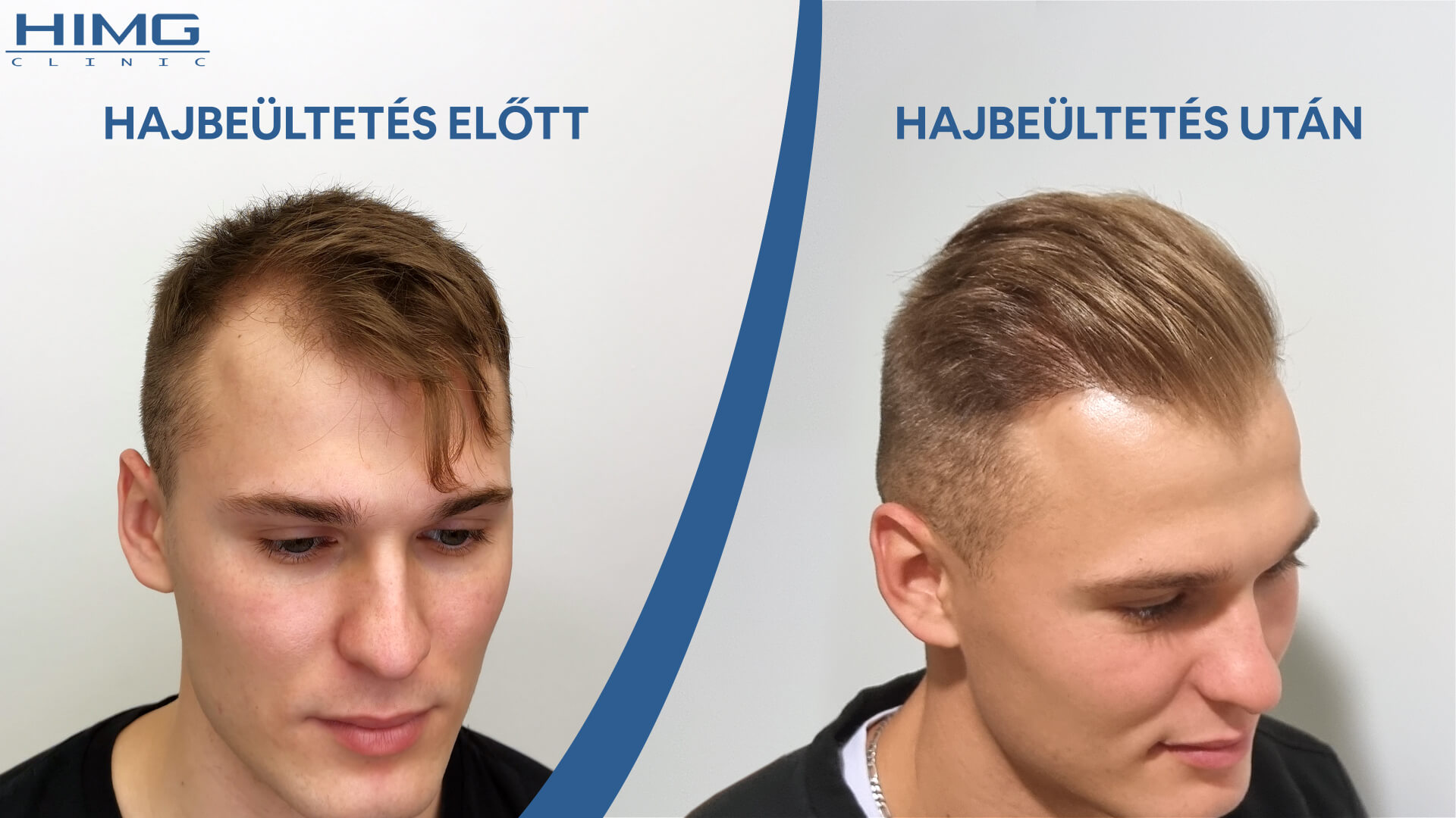 Hajbeültetés előtt és után