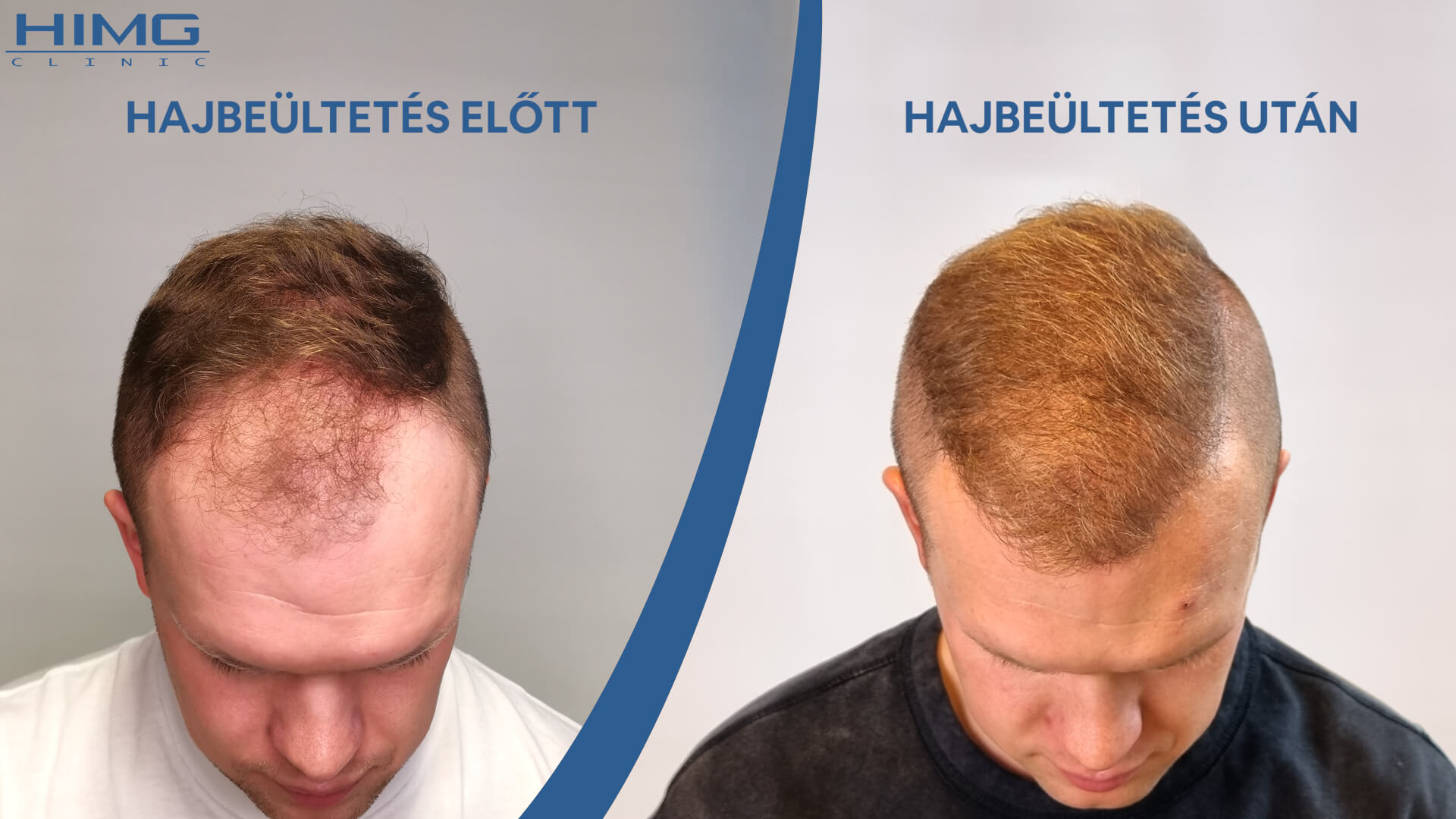 Hajbeültetés eredménye: előtte - utána