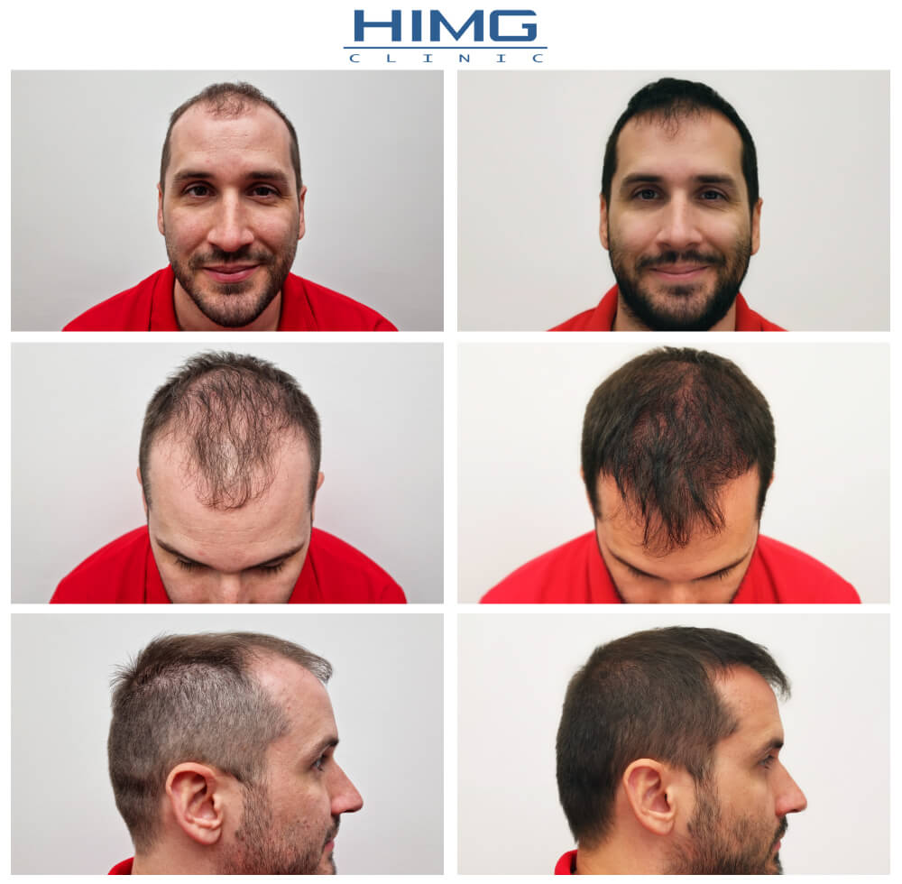 Hajátültetés HIMG klinika