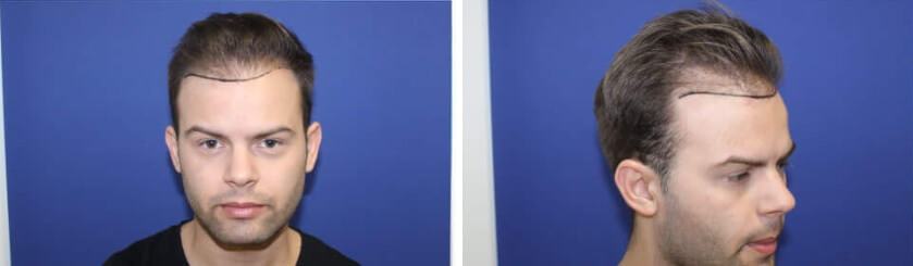 Kopaszodás jelei Kopaszodás jelei