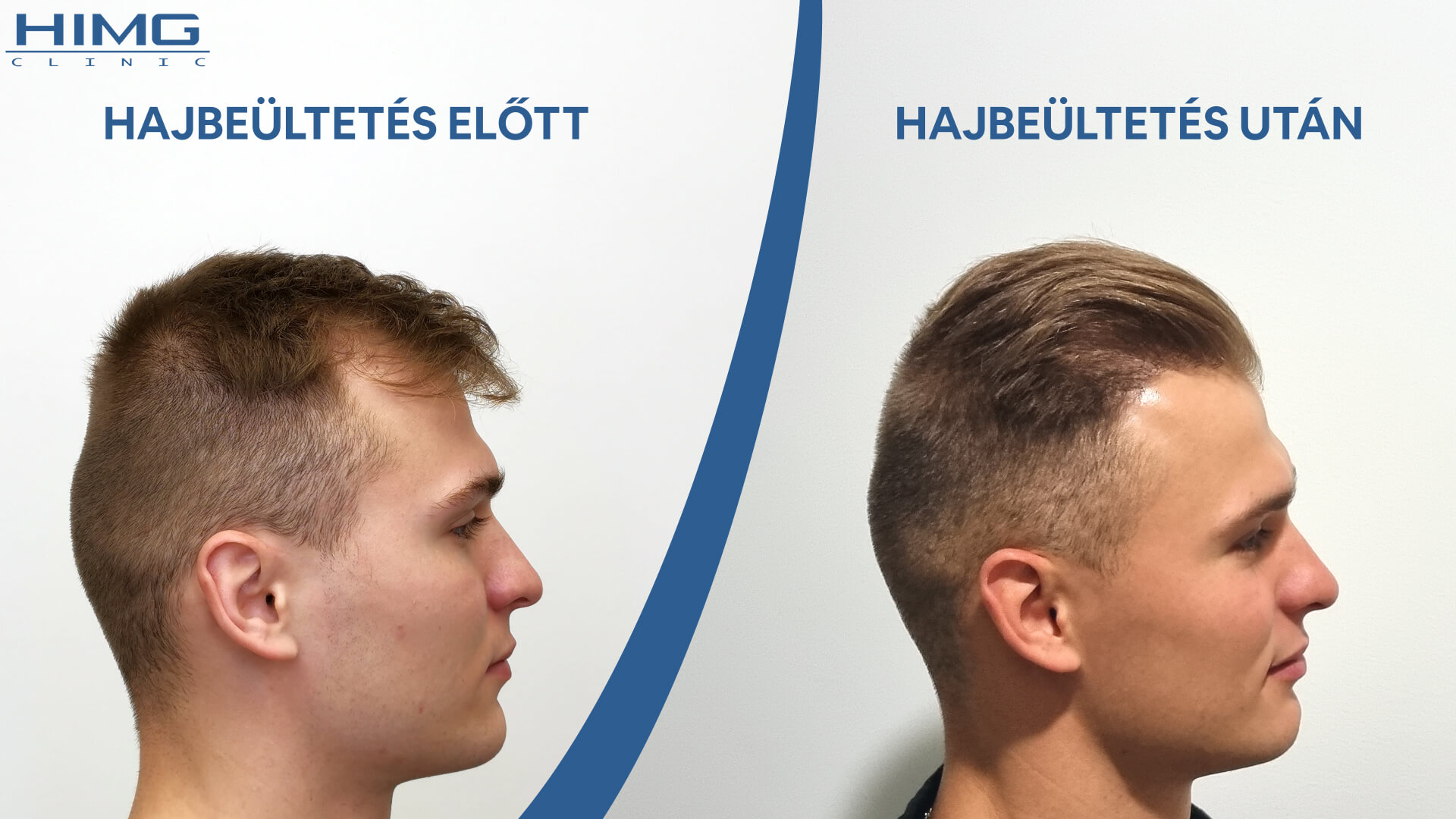 Hajbeültetés eredménye - Előtte és Utána
