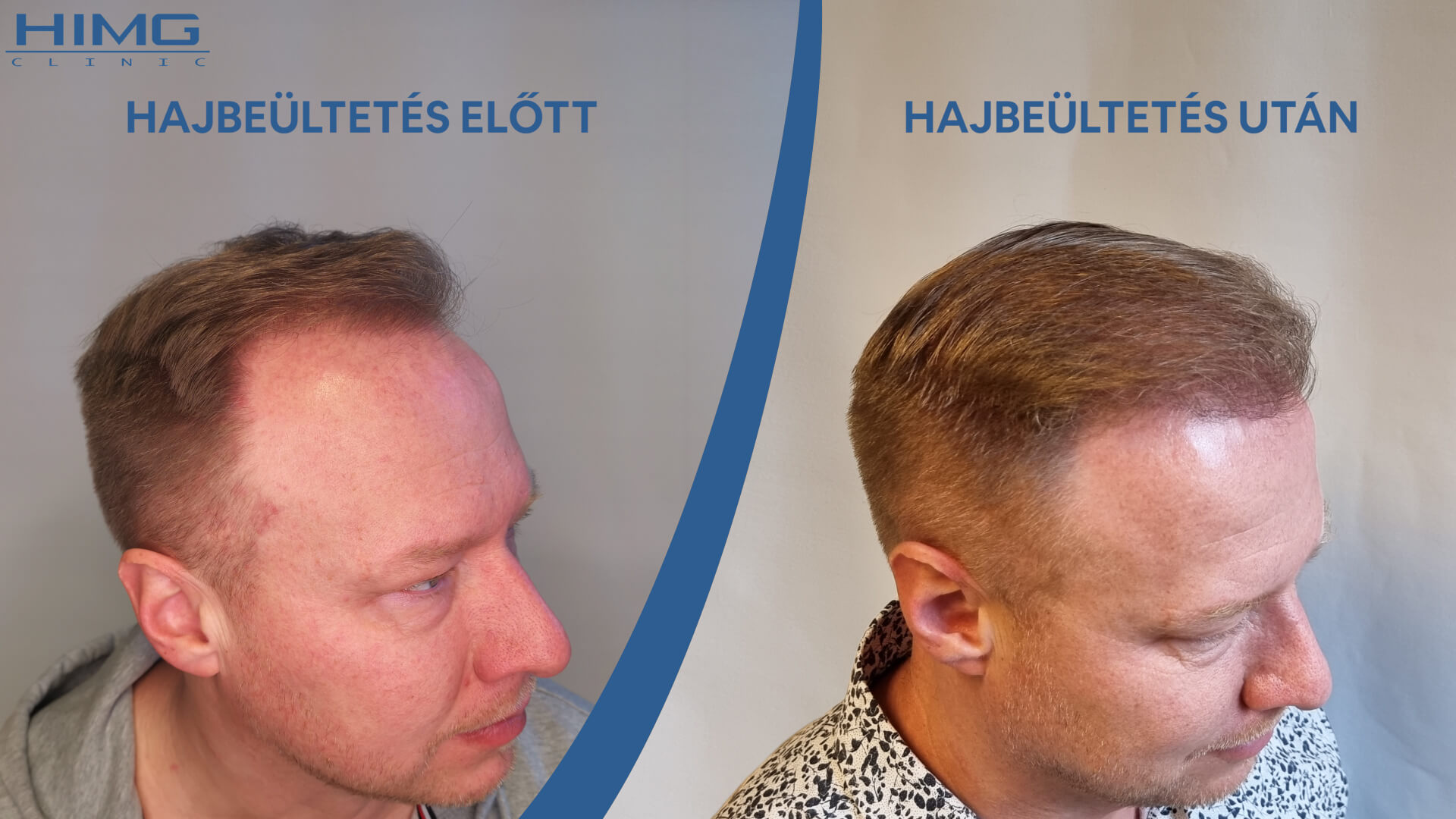 Hajbeültetés előtte & utána eredménye – 4000+ hajszál