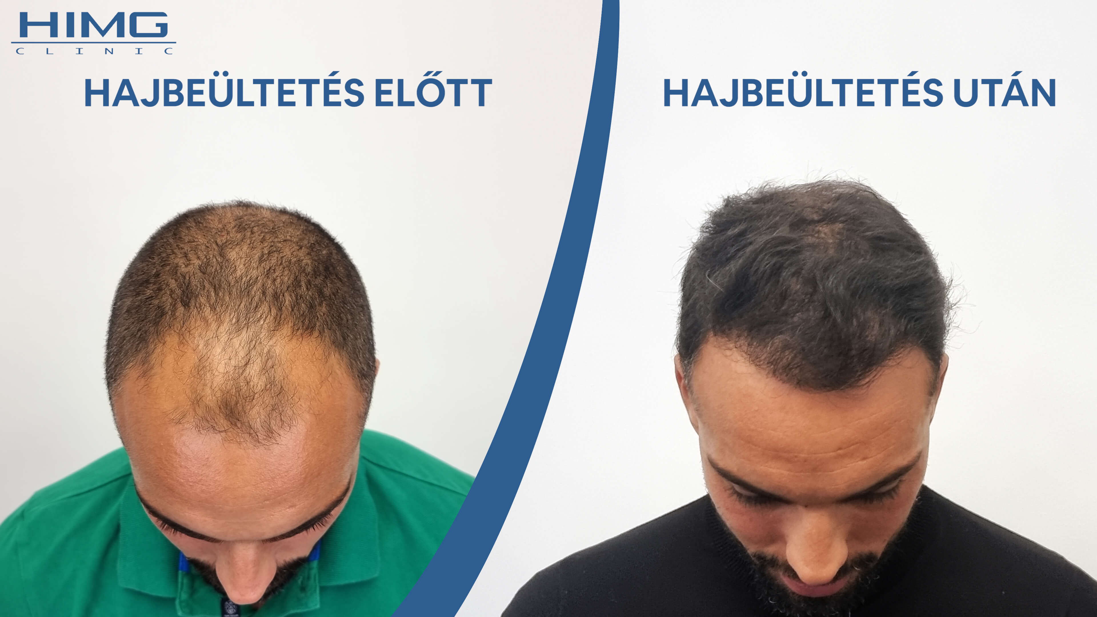 Hajbeültetés Eredmény Előtte-Utána