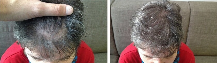 Női kopaszodás kezelése Női kopaszodás kezelése