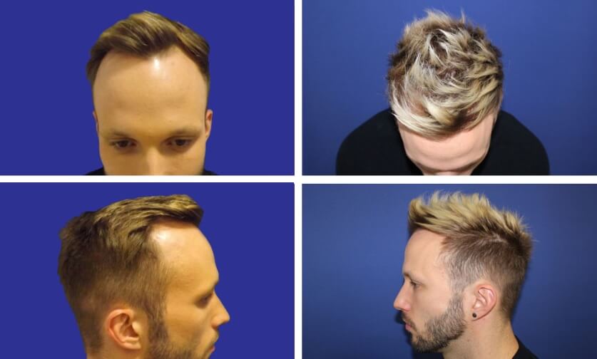 Sikeres hajbeültetés Sikeres hajbeültetés